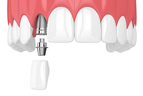 dental implant and crown replacing a single missing tooth 