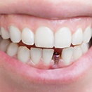 person smiling with a visible dental implant abutment 