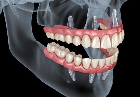 3D graphic of All-on-4 dental implants