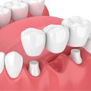 illustration traditional dental bridge in Loveland     