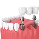 illustration implant dental bridge in Loveland     