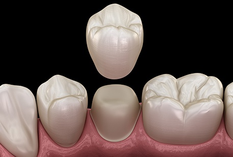 Animated smile with dental crown placement