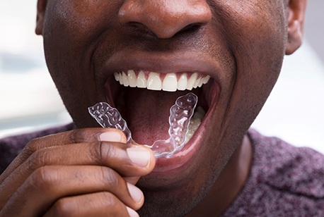 a person putting Smart Moves clear aligners in their mouth