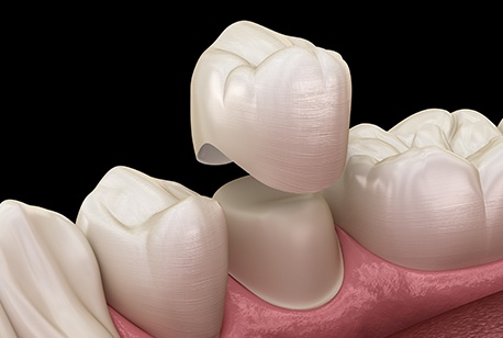 Animated dental crown placement