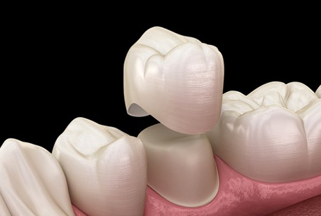 diagram of dental crown being placed over bottom tooth