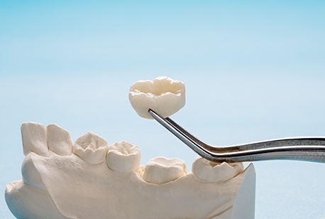 Forceps holding dental crown over model jaw