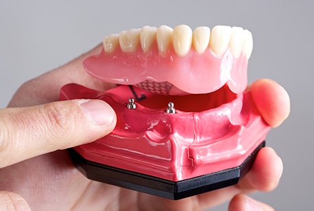 Model implant supported denture