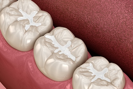 3D render of tooth-colored fillings