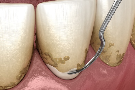 Animated scaling and root planing treatment process