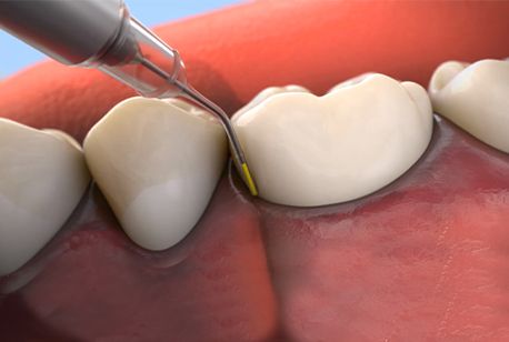 Animated Arestin antibiotic therapy treatment process