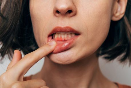 Lady shows inflamed gums