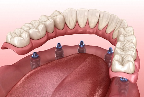 Diagram of an implant denture in Loveland