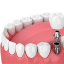 single dental implant in Loveland     