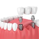 implant bridge in Loveland     