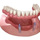 implant denture in Loveland  