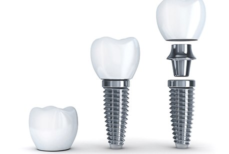 dental implant post, abutment, and crown