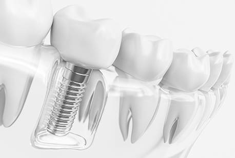 Animated implant supported dental crown