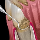 The process of scaling and root planing often requires two appointments and two main stages
