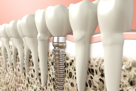 An up-close look at a digital graphic showing a single tooth dental implant sitting between health teeth along an arch