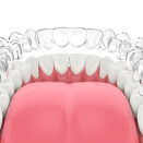 Illustration of clear aligner being placed on teeth in lower arch