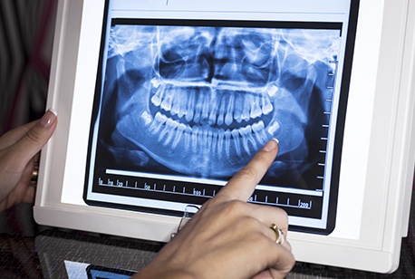 Full smile digital x-rays on computer screen