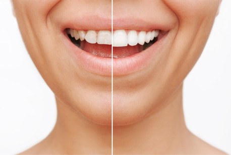 Closeup of patient's smile before and after veneers