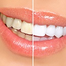 Closeup of woman’s smile before/after whitening