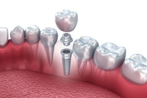 Model showing dental implant candidate. 