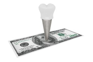 Image representing dental implant cost