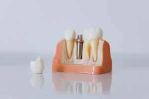 Model used during consultation for dental implants