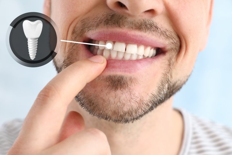 man smiling and pointing to implant dentures