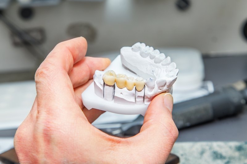 Dental bridge on clay model