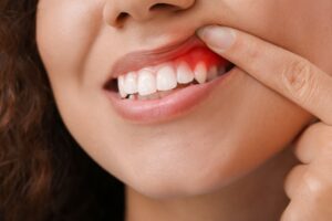 Close-up of red, inflamed gums. 