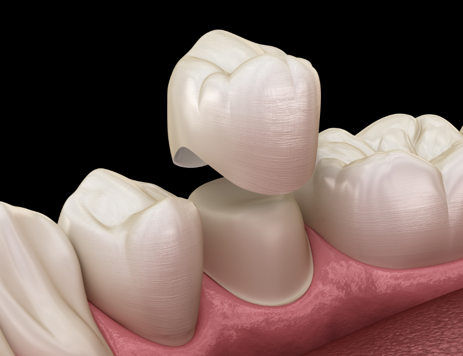 3D image of a dental crown